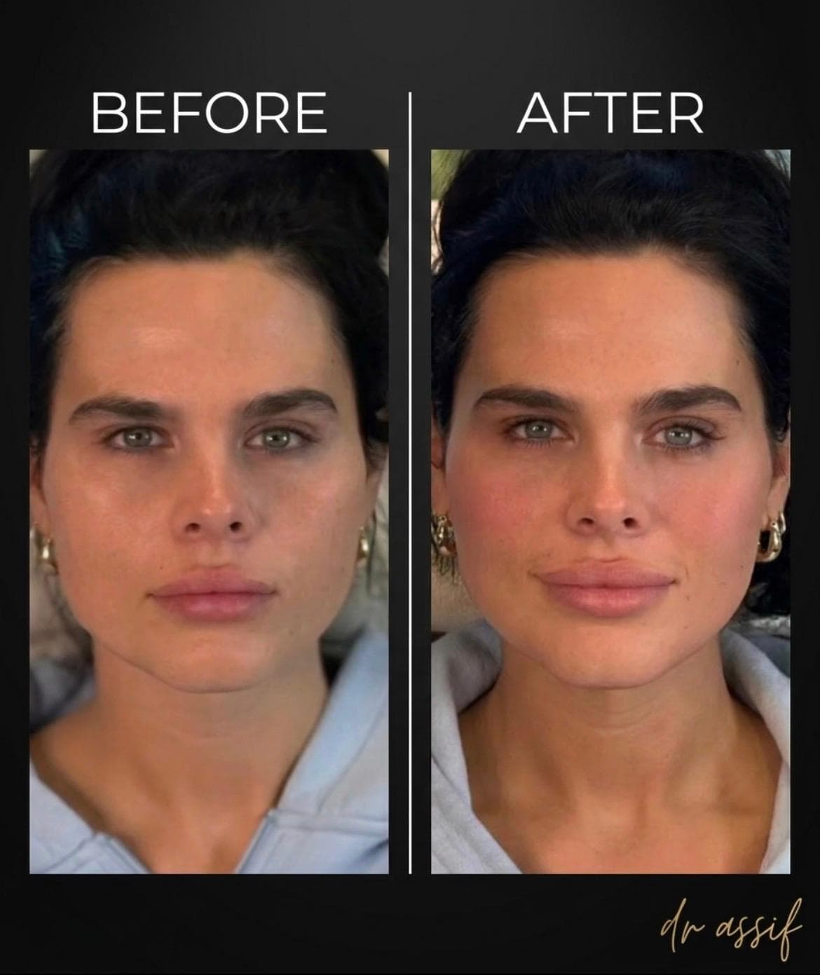 Facelift Transformation