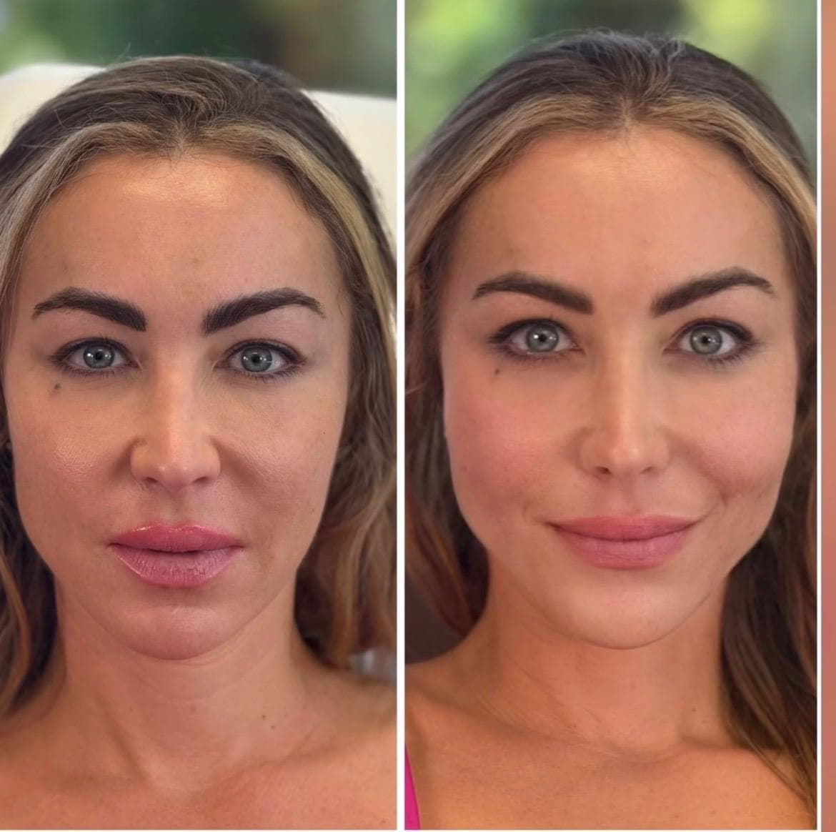 Cheek Enhancement