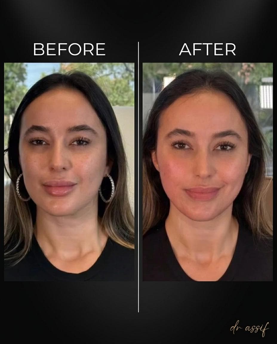 Lip Enhancement Results