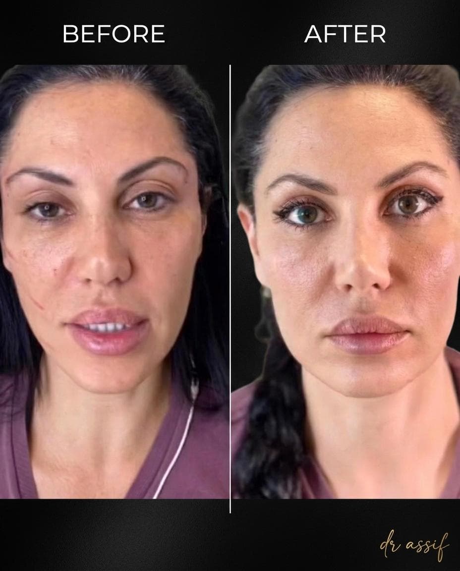 Under-Eye Correction