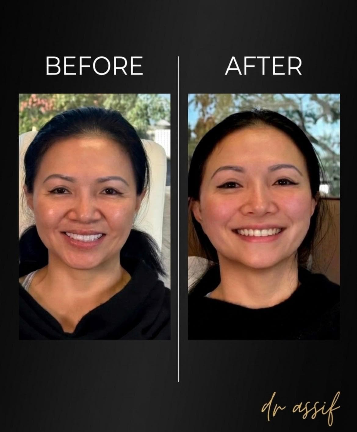 Skin Rejuvenation Results