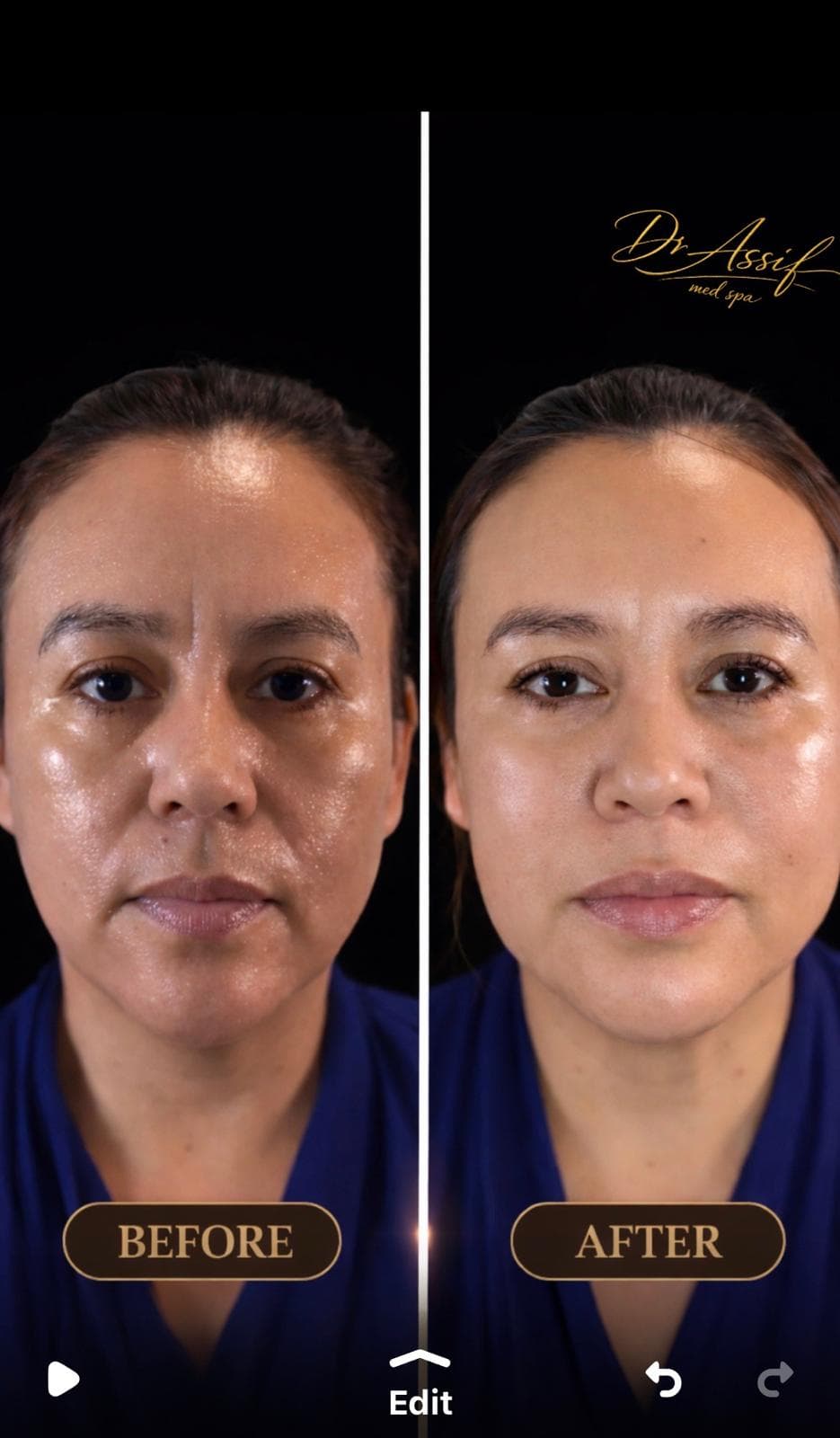 Skin Rejuvenation — Laser Glow